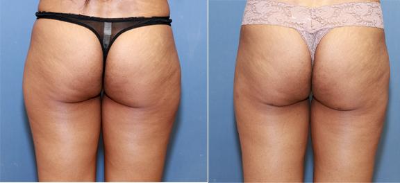 liposuction of saddlebags and thighs for an athlete